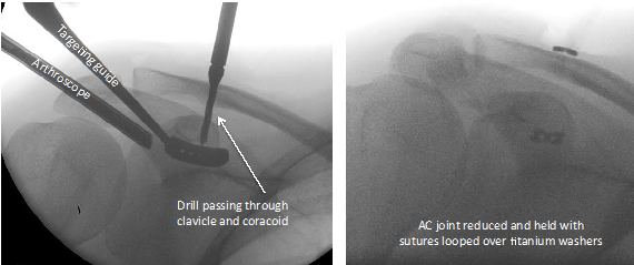 Acromioclavicular Joint Repair And Reconstruction